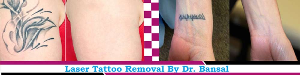 Laser Tattoo Removal treatment in chandigarh